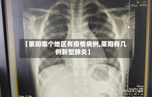 【莱阳哪个地区有疫情病例,莱阳有几例新型肺炎】